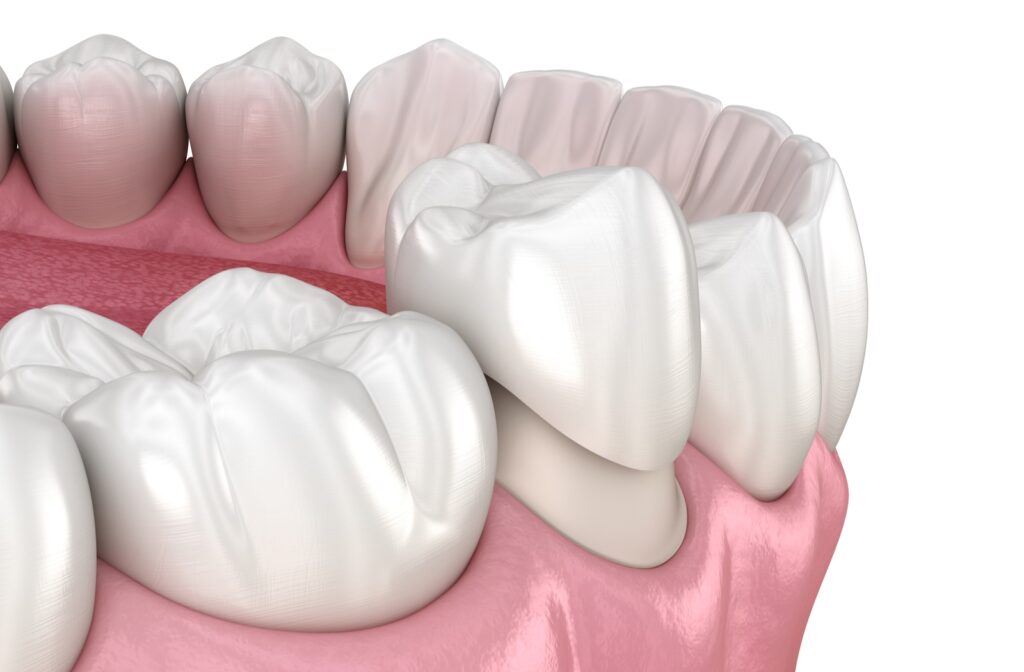 6 Interesting Facts About Zirconium Crown · Livera Dental Clinic Florya Istanbul