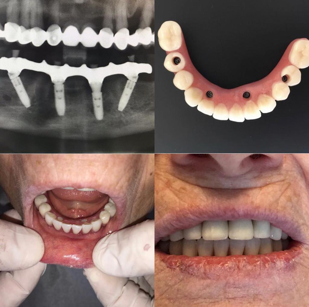 What is the All on Four Implant Technique? · Livera Dental Clinic Florya Istanbul