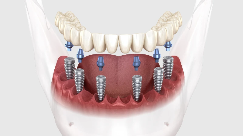What is All-on-Six Implant, Why Is It Used and How Is It Performed? | Livera Dental Clinic