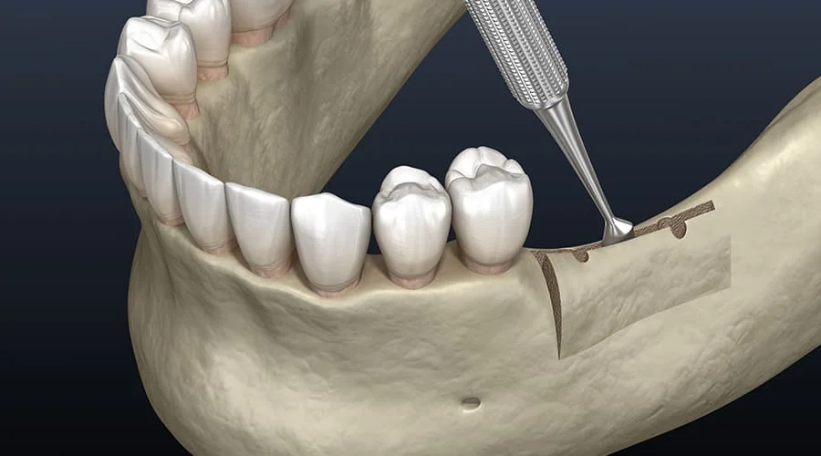 What is Alveoloplasty? How is it Performed and Post-Care? · Livera Dental Clinic Florya Istanbul