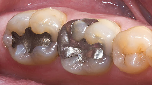 Amalgam dolgular nedir? Zararları nelerdir? · Livera Dental Clinic Florya İstanbul