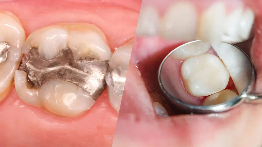 Kompozit Dolgu Nedir? · Livera Dental Clinic Florya İstanbul