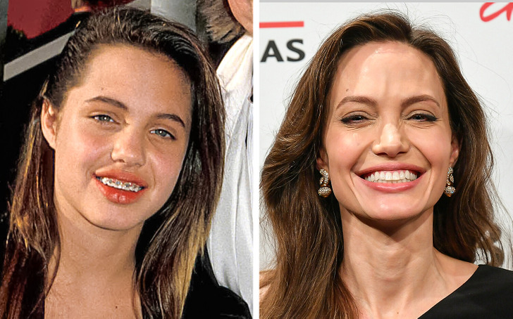 Angelina Jolie Teeth: The Science and Art Behind a Famous Smile · Livera Dental Clinic Florya Istanbul
