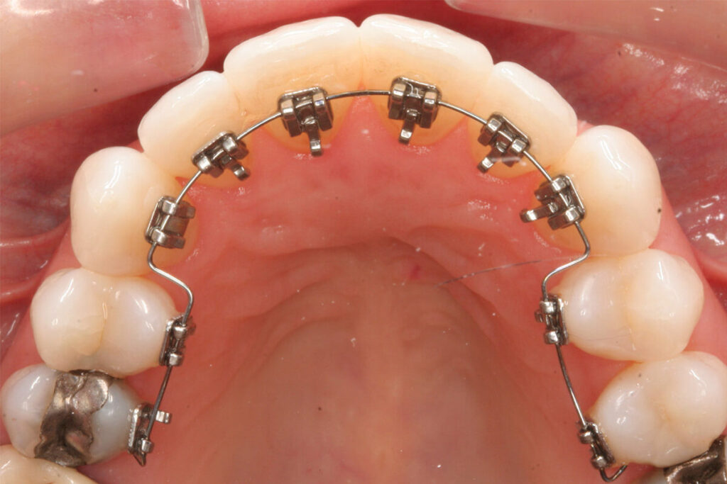How Long Does it Take to Straighten Teeth With Braces? · Livera Dental Clinic Florya Istanbul