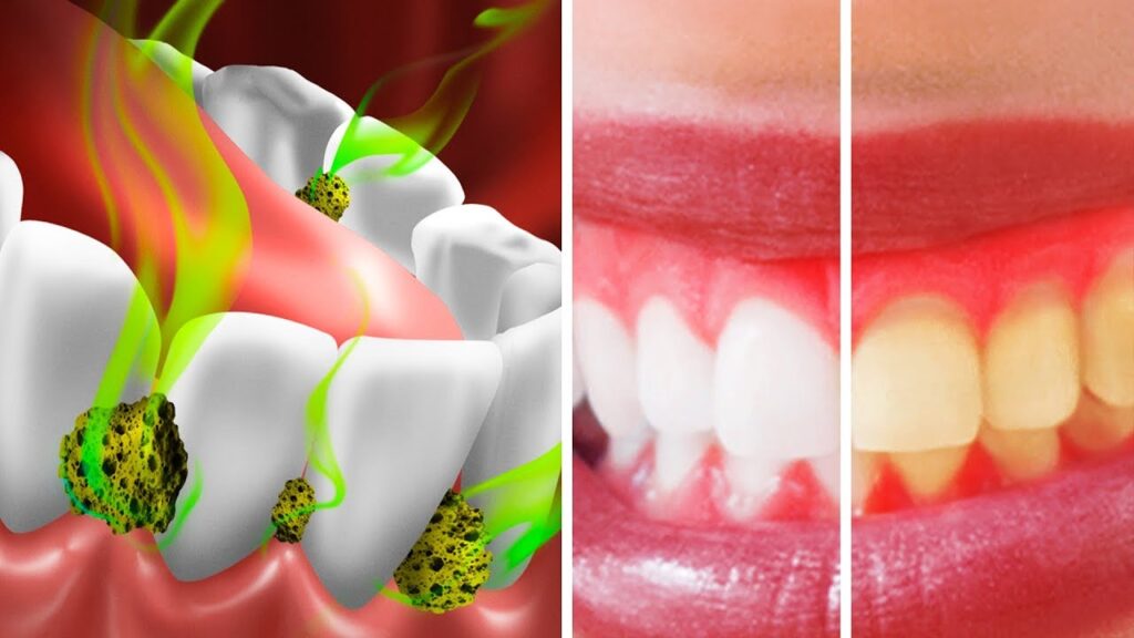 Ağızdaki Bakteriler Nasıl Öldürülür? · Livera Dental Clinic Florya İstanbul
