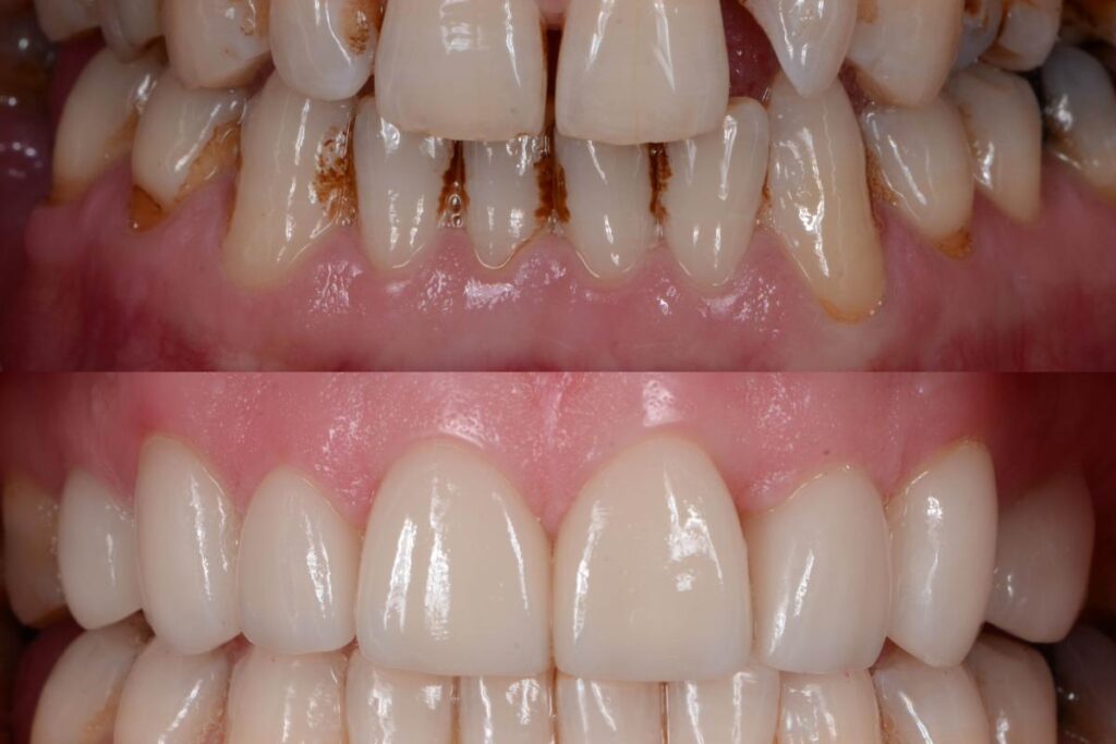 Diş Kaplamalarıyla Ünlü Bir Gülümsemeye Kavuşun · Livera Dental Clinic Florya İstanbul
