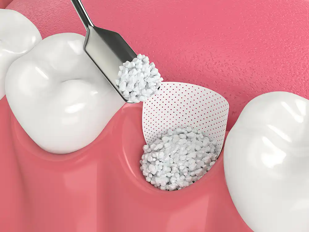 Diş Eti Grefti Ameliyatı Yöntemleri ve Uygulama Süreçleri · Livera Dental Clinic Florya İstanbul