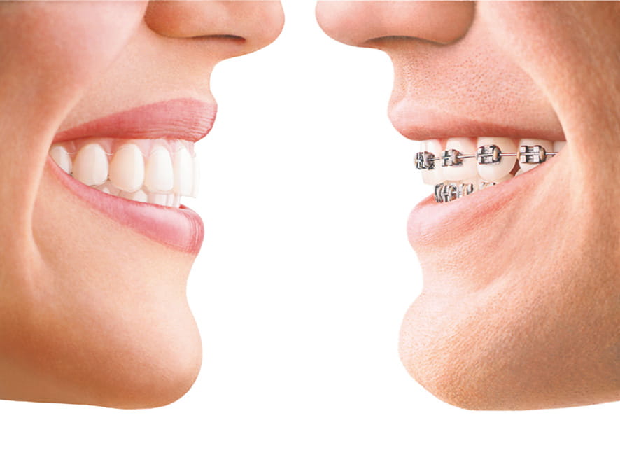Braces or Clear Aligners: Which Option Suits You Best? · Livera Dental Clinic Florya Istanbul