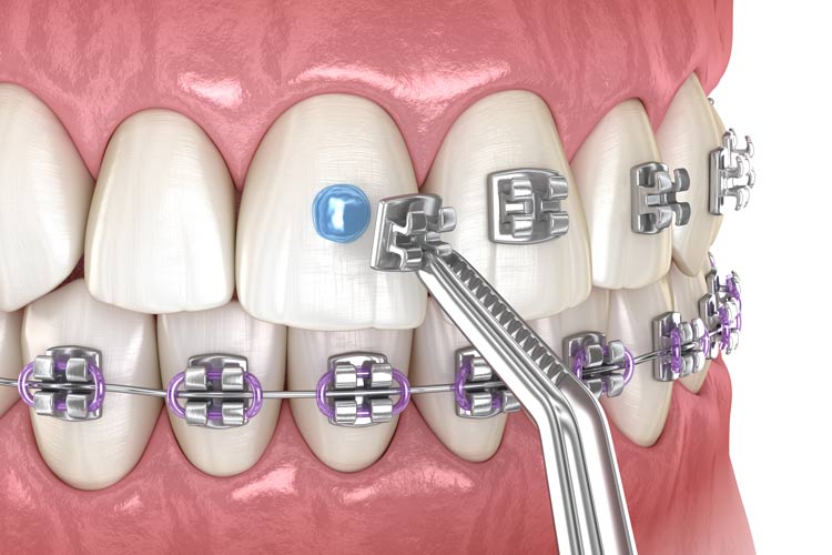 How Long Does it Take to Straighten Teeth With Braces? · Livera Dental Clinic Florya Istanbul