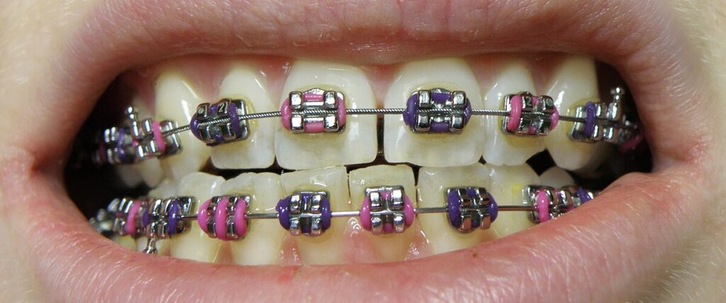 What is a Bracket? Types and Varieties · Livera Dental Clinic Florya Istanbul