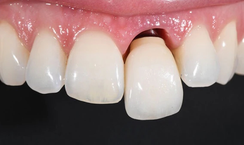 loose teeth What Should Be Done About Loose Teeth? · Livera Dental Clinic Florya Istanbul