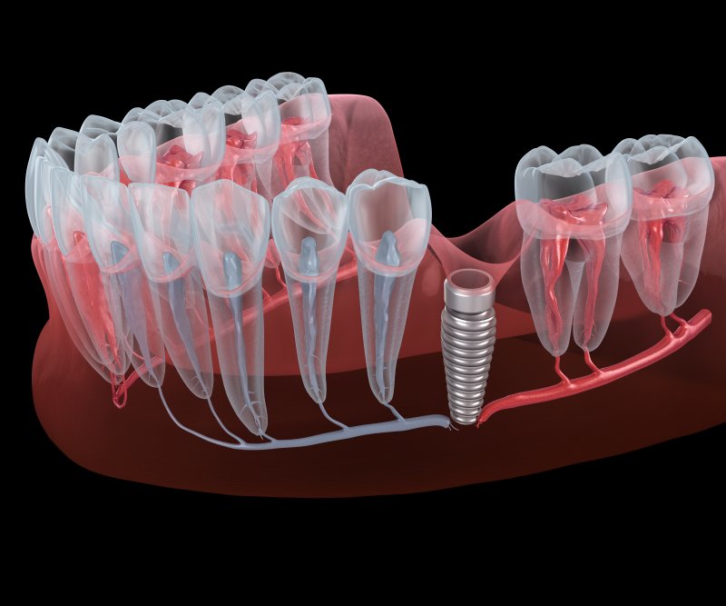 Can Dental Implants Be Removed? Clinical and Scientific Analysis | Livera Clinic · Livera Dental Clinic Florya Istanbul
