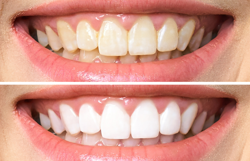 Can Veneers Be Whitened? · Livera Dental Clinic Florya Istanbul
