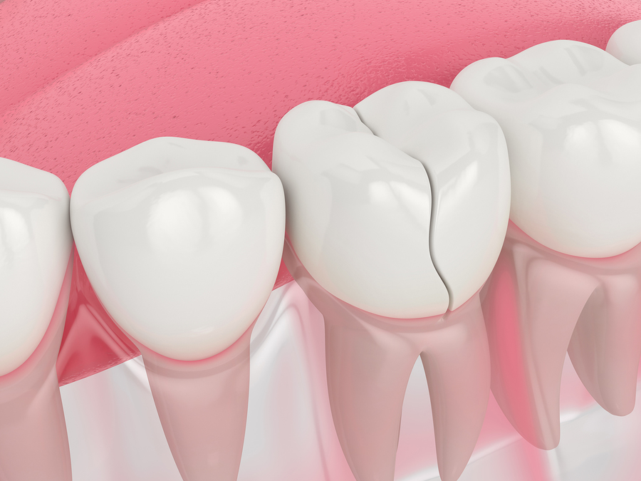Broken Tooth Repair: Treatment Options and Guidelines · Livera Dental Clinic Florya Istanbul