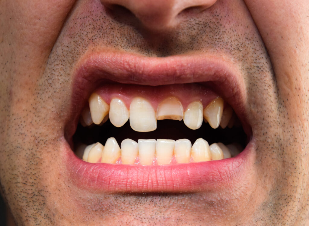 Cracked Teeth: What Are They, Why Do They Occur, and How Are They Treated? · Livera Dental Clinic Florya Istanbul