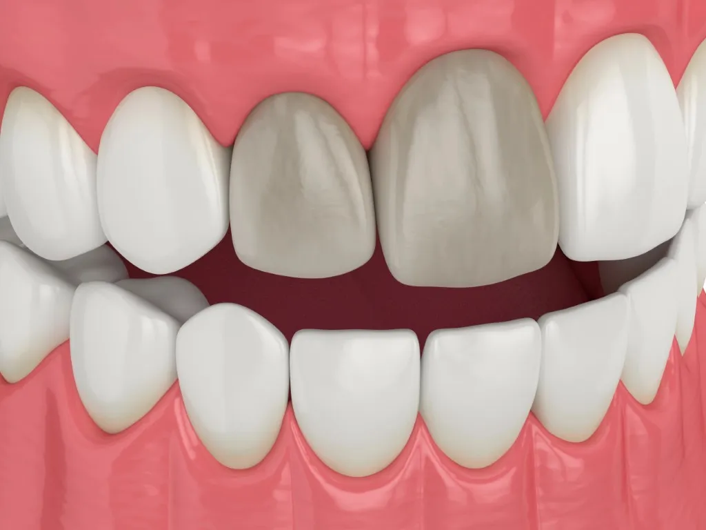 How to Save a Dead Tooth? Causes, Symptoms, and Prevention Methods · Livera Dental Clinic Florya Istanbul
