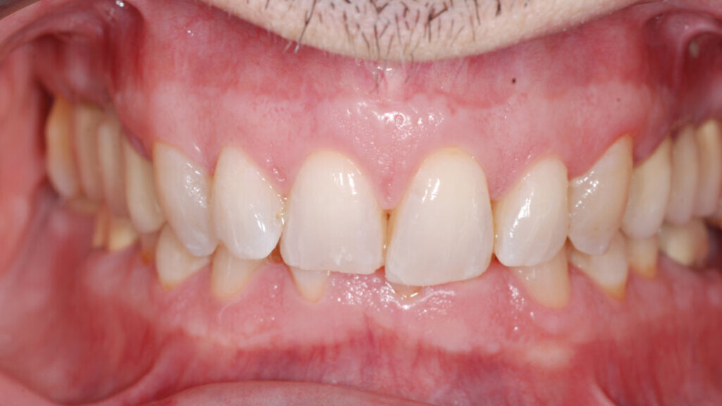 Derin Isırık Nedir ve Nasıl Tedavi Edilir? · Livera Dental Clinic Florya İstanbul
