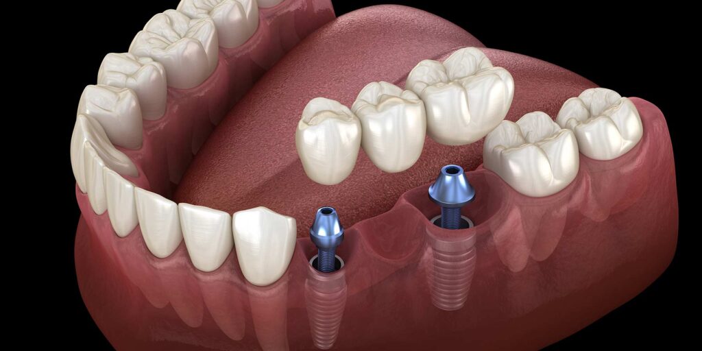 What is a Dental Bridge and How is it Made? Bridge Prices · Livera Dental Clinic Florya Istanbul