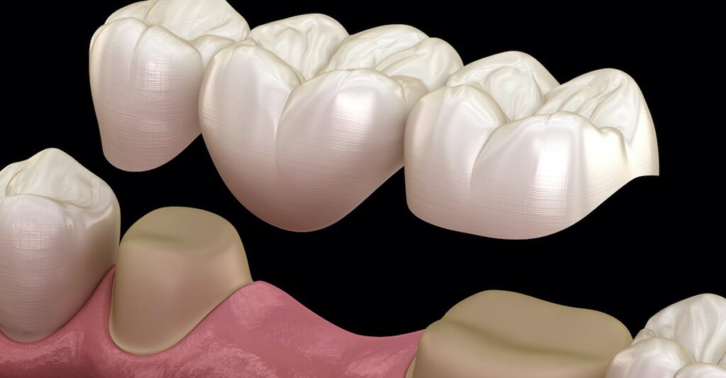 What is a Dental Bridge? Types, Benefits, and Application Process · Livera Dental Clinic Florya Istanbul