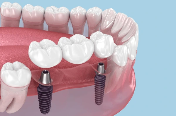 What is a Dental Bridge and How is it Made? Bridge Prices · Livera Dental Clinic Florya Istanbul