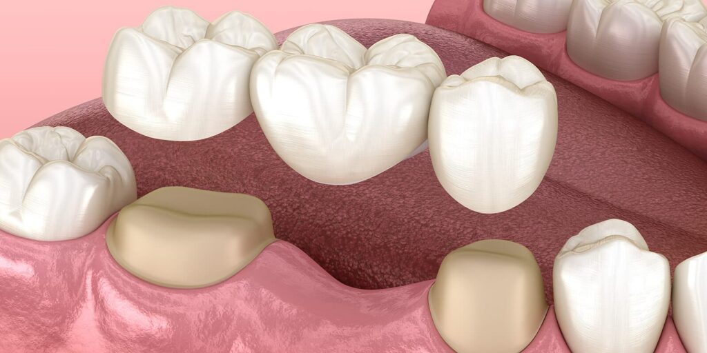 dental crown Diş Kronu Onarımı: İşlem Aşamaları ve Maliyet Rehberi · Livera Dental Clinic Florya İstanbul