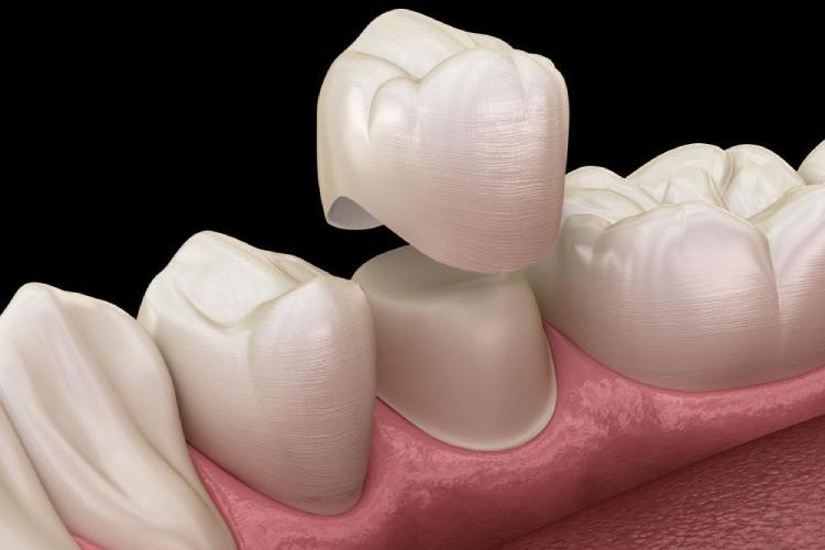 Diş Kronu Onarımı: İşlem Aşamaları ve Maliyet Rehberi · Livera Dental Clinic Florya İstanbul