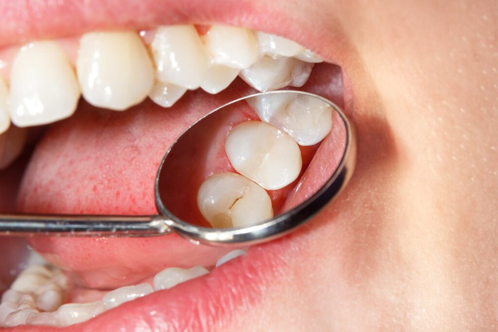 What is Dental Filing (Microcontouring)? · Livera Dental Clinic Florya Istanbul