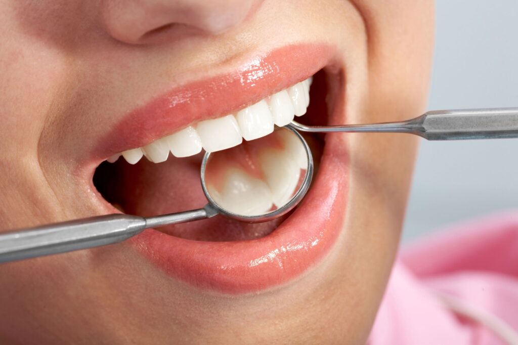 What is Dental Filing (Microcontouring)? · Livera Dental Clinic Florya Istanbul