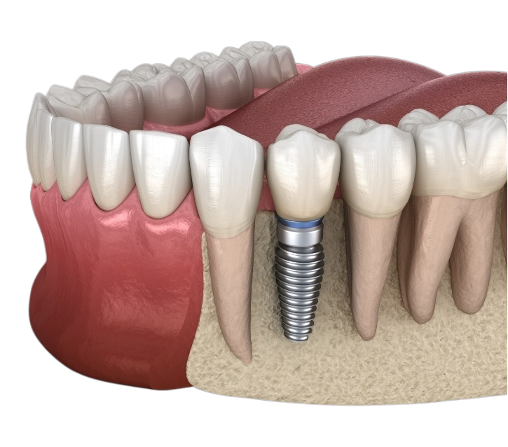 Diş İmplant Abutment Nedir? Rolü ve Önemi · Livera Dental Clinic Florya İstanbul