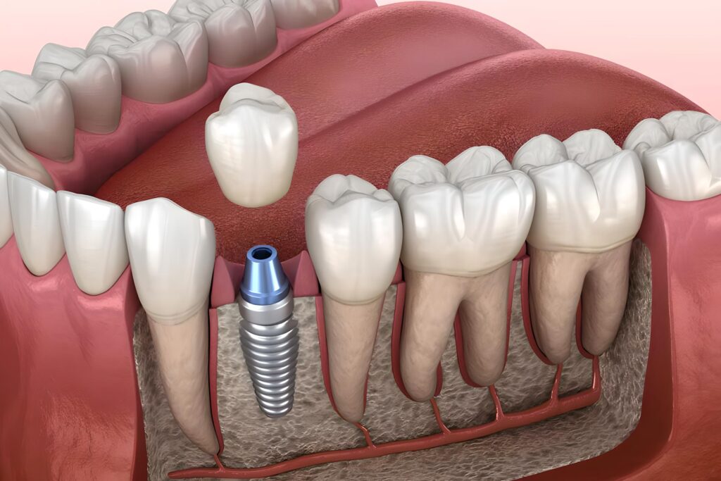 What Are the Stages of Healing in Dental Implants? · Livera Dental Clinic Florya Istanbul