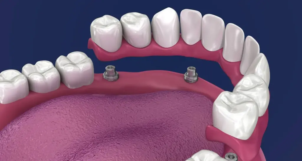 Can You Get a Dental Implant from the NHS? · Livera Dental Clinic Florya Istanbul