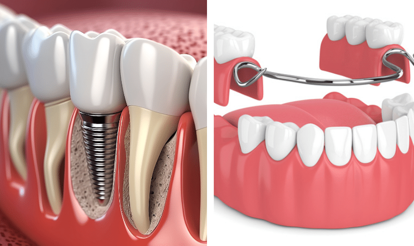 Implant vs. Prosthesis: Functions, Structure, and Costs · Livera Dental Clinic Florya Istanbul