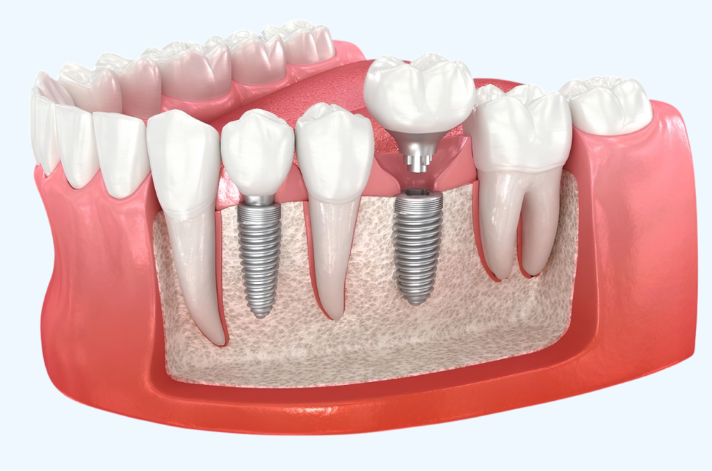 Diş İmplant Abutment Nedir? Rolü ve Önemi · Livera Dental Clinic Florya İstanbul