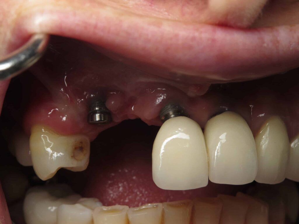 Diş İmplantı Başarısızlığı: Mitler ve Gerçekler · Livera Dental Clinic Florya İstanbul