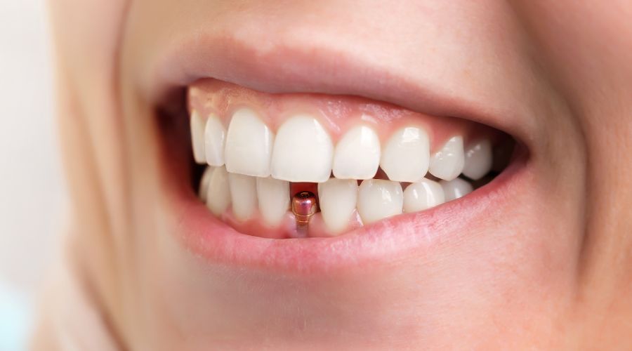 Ön Dişler İçin Diş İmplantları · Livera Dental Clinic Florya İstanbul