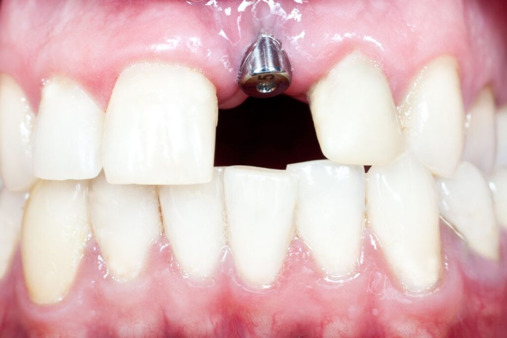 Dental Implants for Front Teeth · Livera Dental Clinic Florya Istanbul