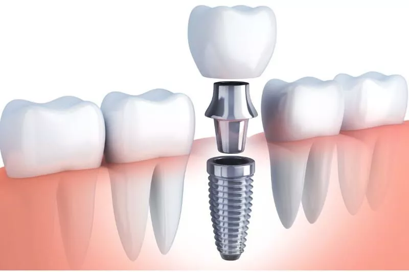 5 Things You Should Do Before Your Dental Implant Treatment · Livera Dental Clinic Florya Istanbul