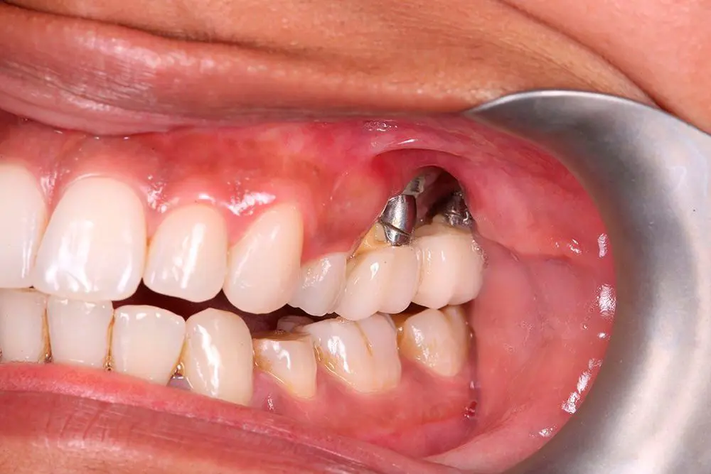 Can Dental Implants Be Removed? Clinical and Scientific Analysis | Livera Clinic · Livera Dental Clinic Florya Istanbul