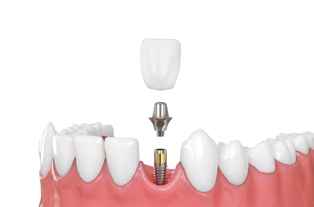 How many dental implants can be placed in one session? · Livera Dental Clinic Florya Istanbul