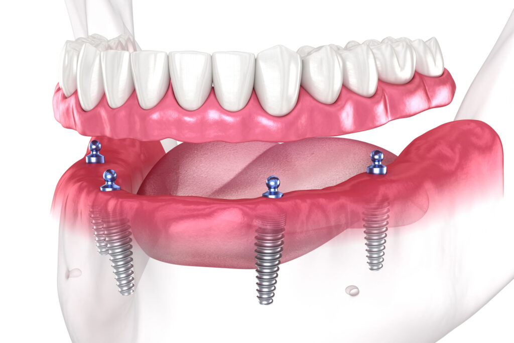 Why Should Dairy Products Not Be Consumed After Dental Implant Surgery? · Livera Dental Clinic Florya Istanbul