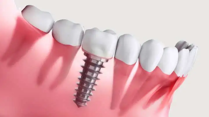 How many dental implants can be placed in one session? · Livera Dental Clinic Florya Istanbul