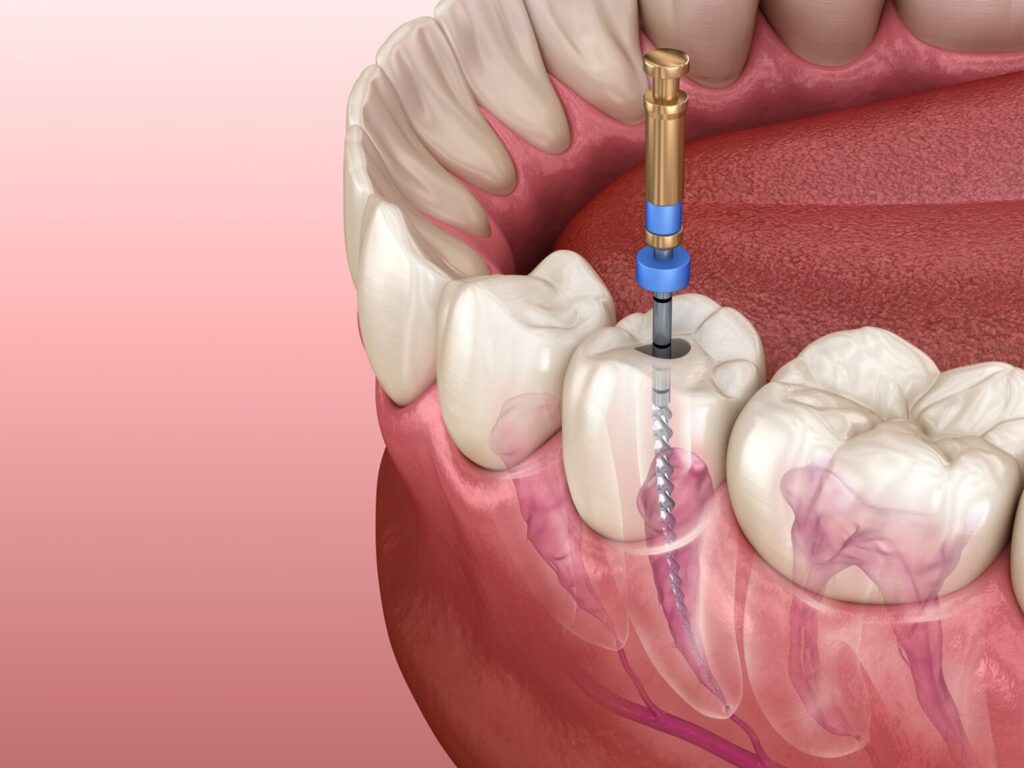 Diş Siniri Ölümü Nedir, Neden Oluşur ve Nasıl Tedavi Edilir · Livera Dental Clinic Florya İstanbul