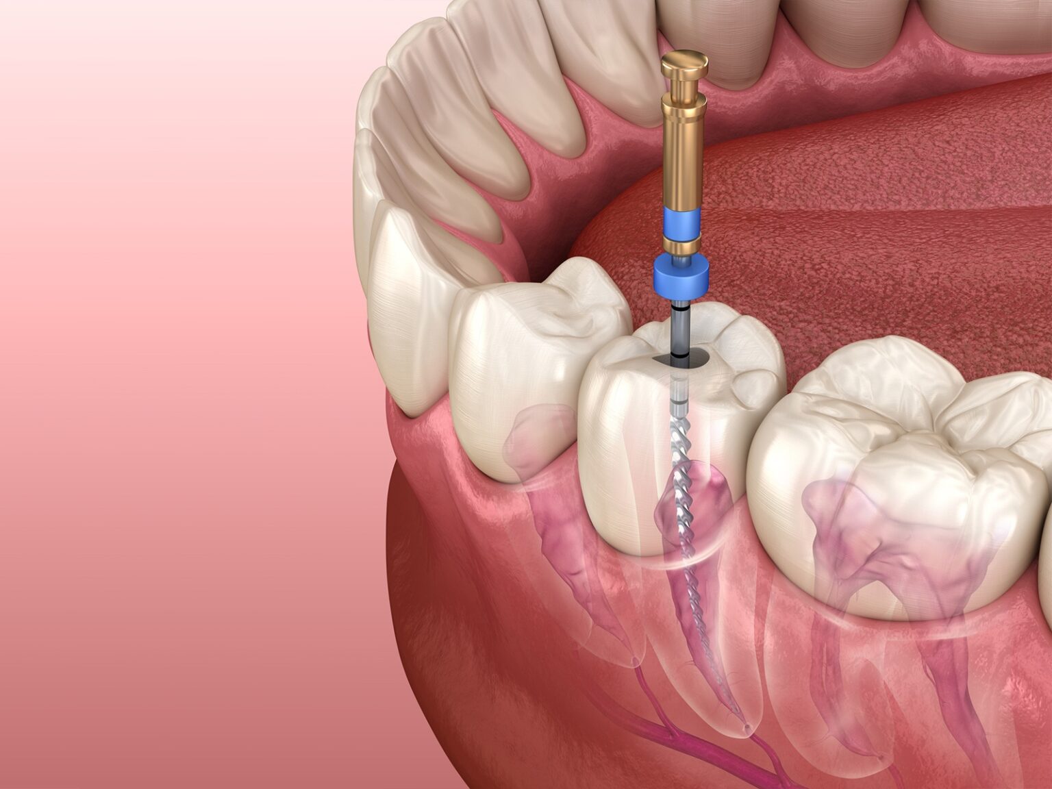 Что такое гибель зубного нерва, почему она возникает и как лечится · Livera Dental Clinic Флория Стамбул