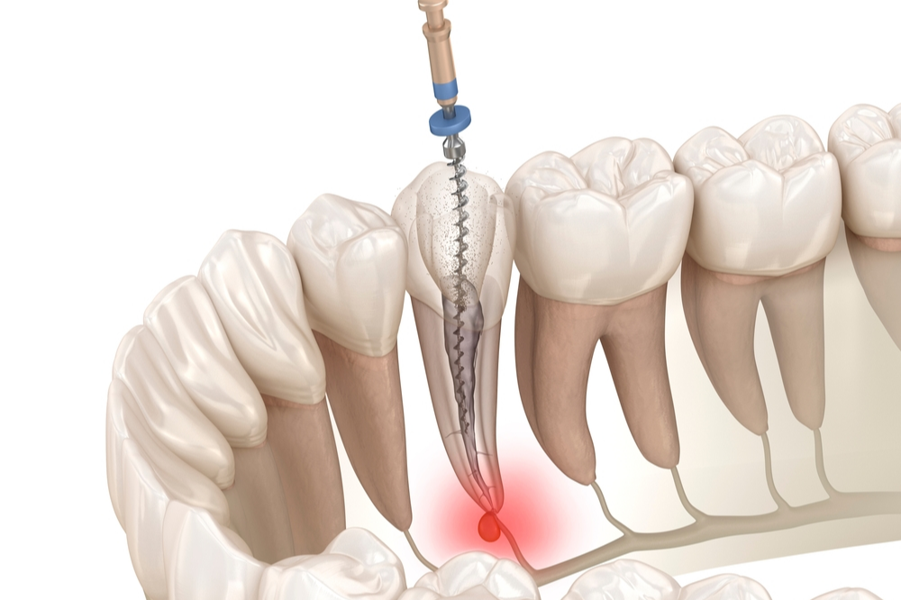 Diş Siniri Ölümü Nedir, Neden Oluşur ve Nasıl Tedavi Edilir · Livera Dental Clinic Florya İstanbul