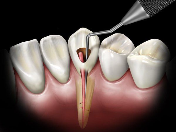 dental nerve Diş Siniri Nasıl Alınır? · Livera Dental Clinic Florya İstanbul