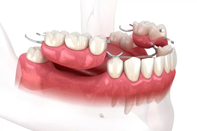 Protezlere Alternatif Diş Tedavileri · Livera Dental Clinic Florya İstanbul