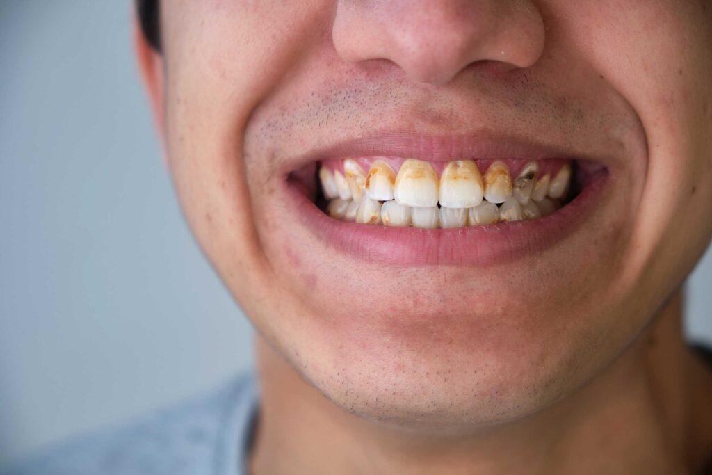 Diş taşı temizliği nasıl yapılır? · Livera Dental Clinic Florya İstanbul