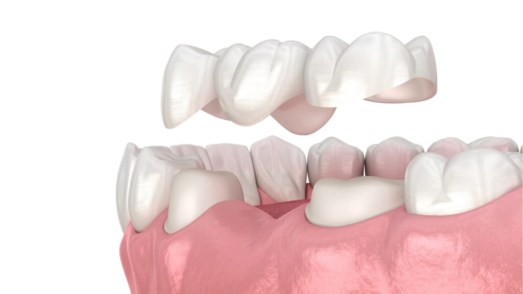 Diş Kaplaması Türleri ve Fiyatları · Livera Dental Clinic Florya İstanbul