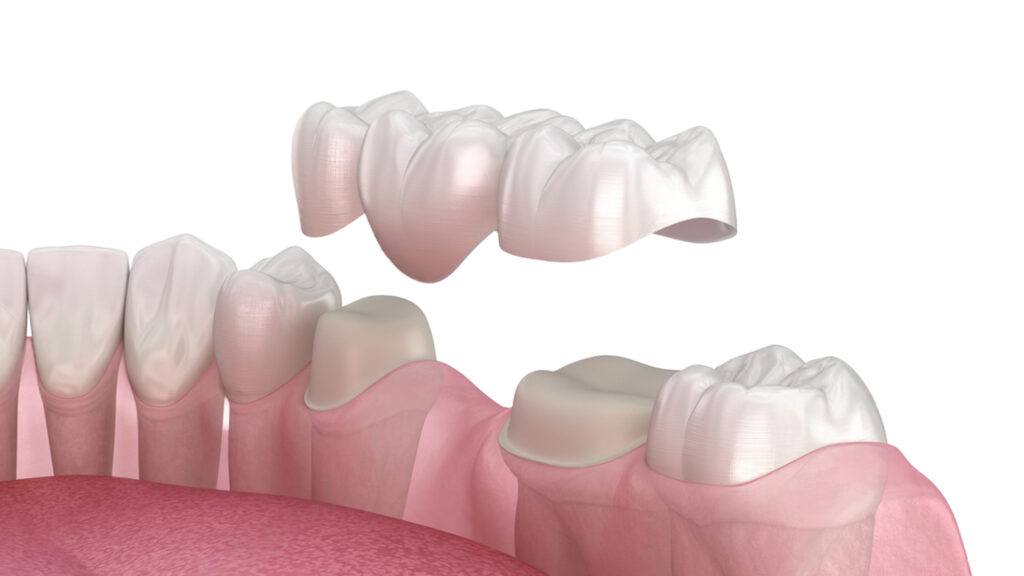 Diş Kaplaması veya Diş Tacı Nedir? Modern Bir Diş Bakış Açısı · Livera Dental Clinic Florya İstanbul