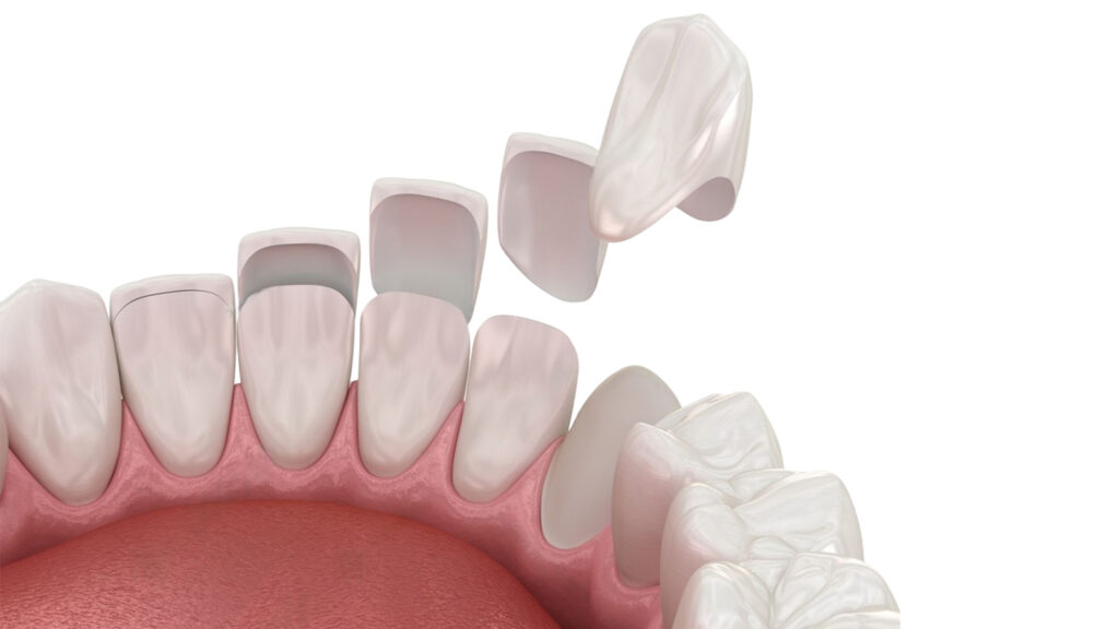 Veneers vs. Crowns: Comparison: Differences, Similarities, and Cost · Livera Dental Clinic Florya Istanbul